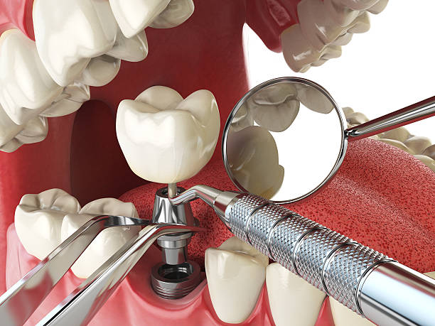 Best Emergency Root Canal Treatment in Long Beach, MD